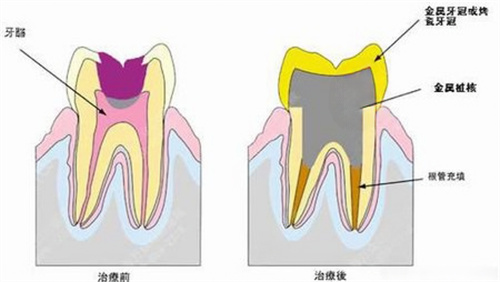 根管治疗前后对比 (1).jpg